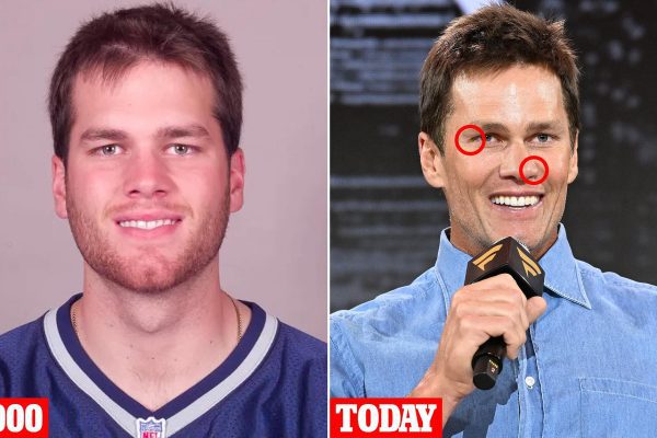 Plastic Surgeons Unveil Secrets Behind Tom Brady’s Evolving Look
