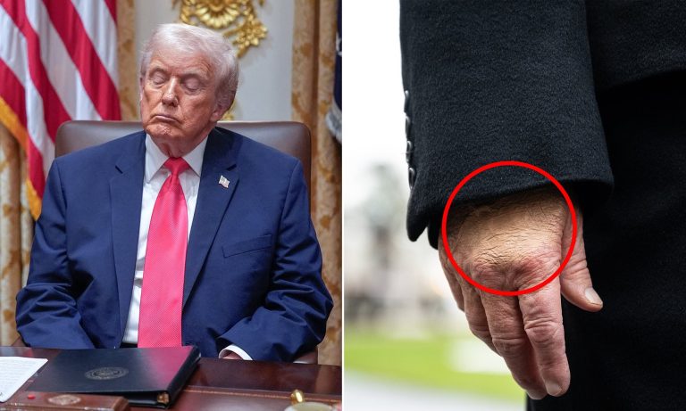 Blood, Bruises, and Sleepless Nights: Trump’s Shocking Health Confession